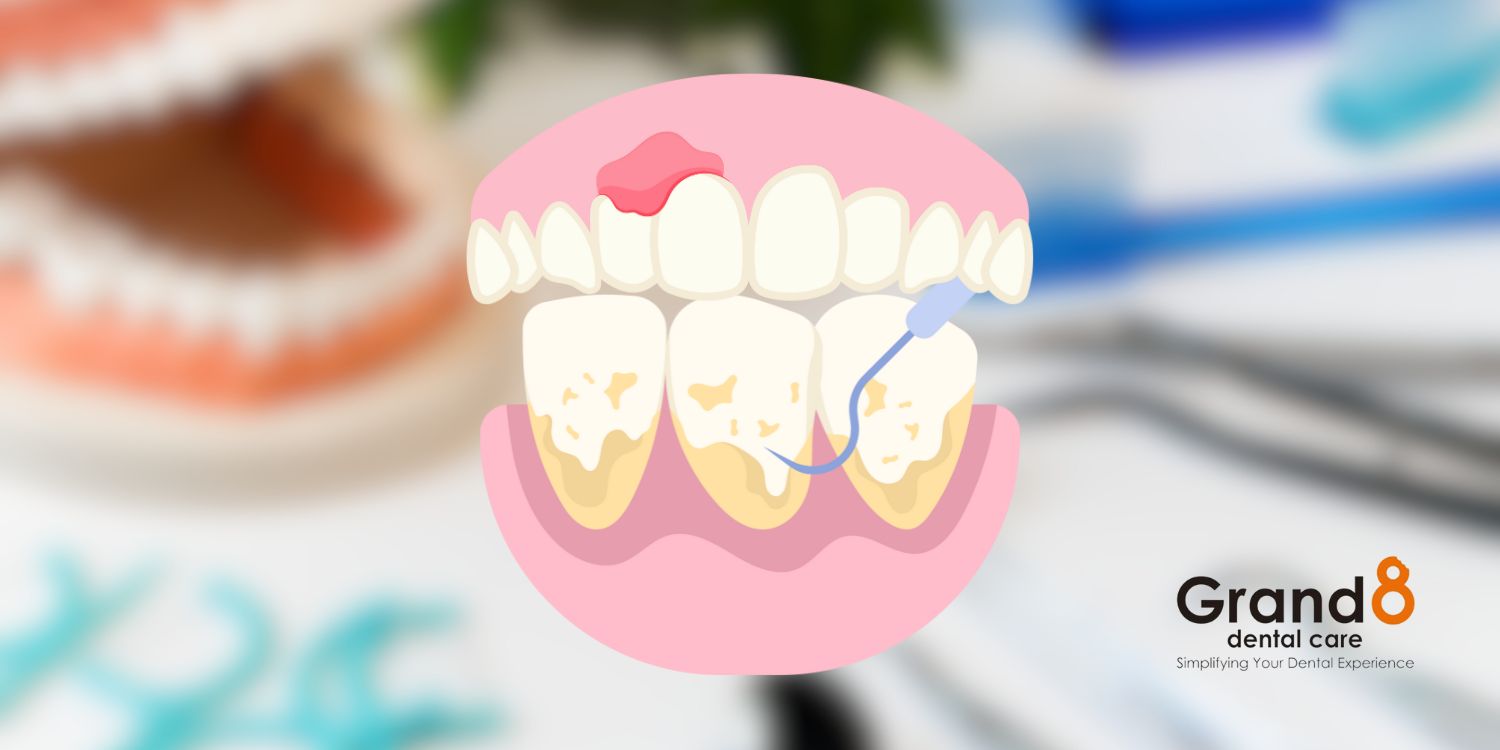 Ilustrasi periodontitis